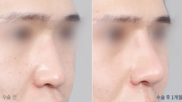 Before/After