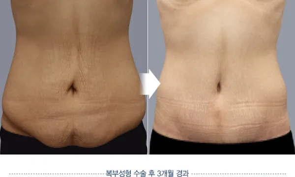 Before/After