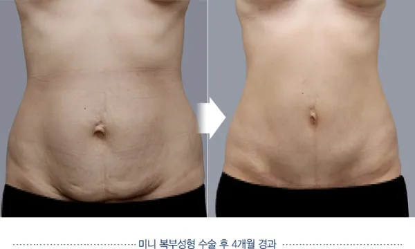 Before/After
