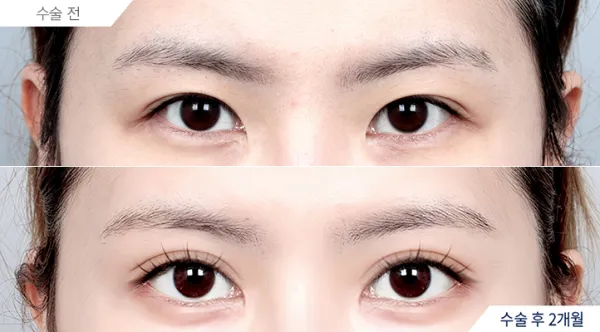 Before/After