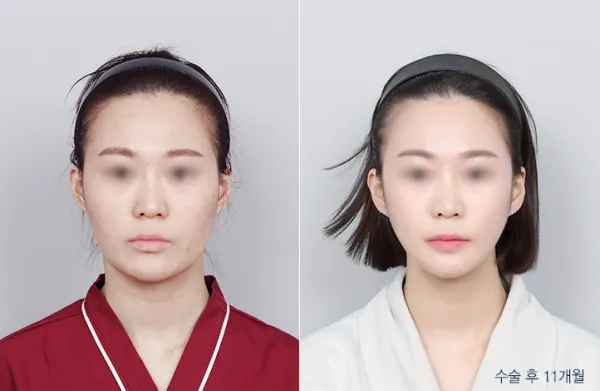 Before/After