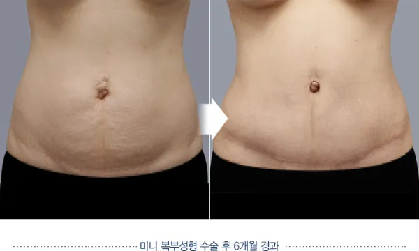 Before/After