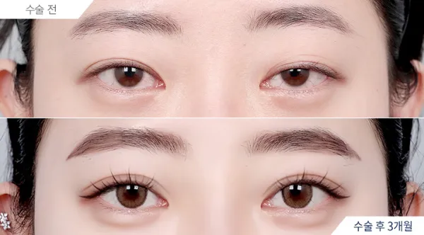 Before/After
