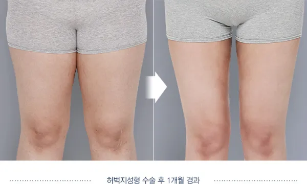 Before/After