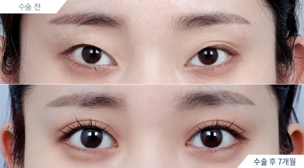 Before/After