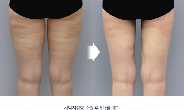 Before/After