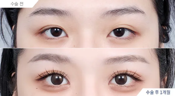 Before/After