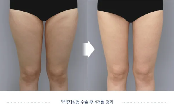 Before/After