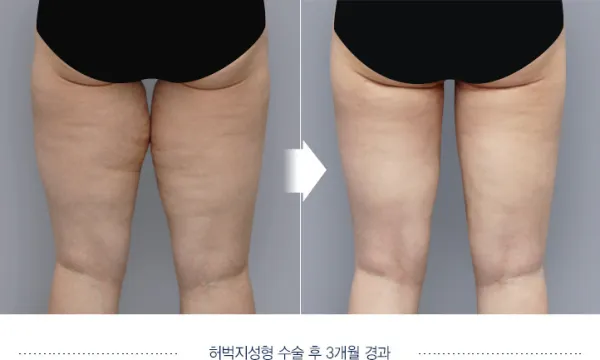 Before/After