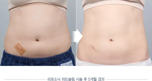 Before/After