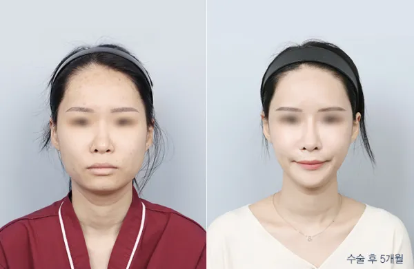 Before/After