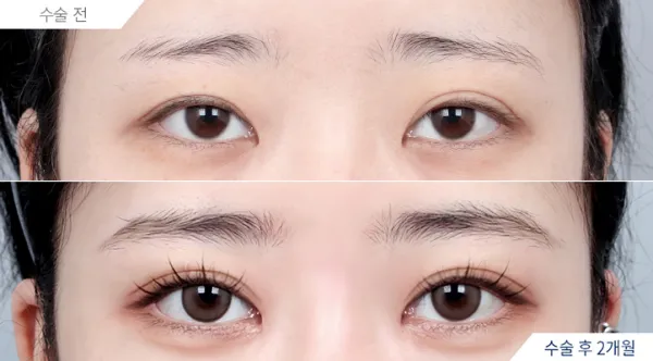 Before/After
