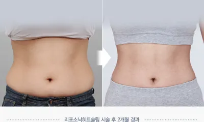 Before & After