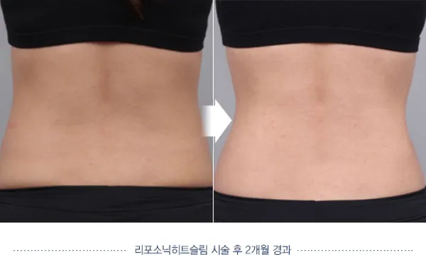 Before/After