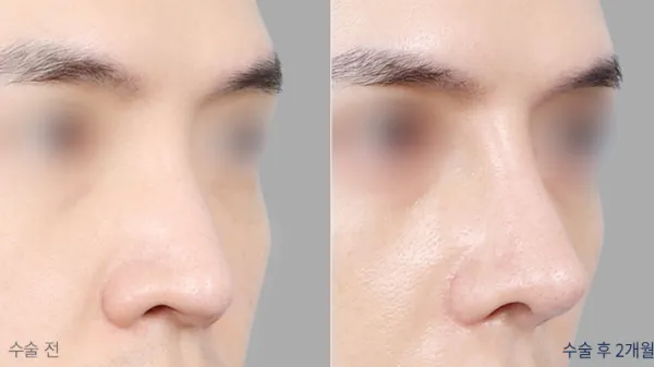 Before/After