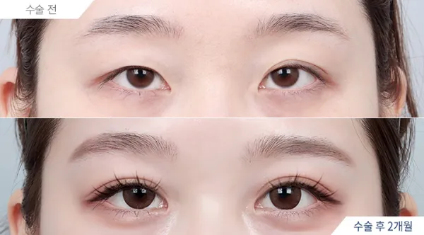 Before/After