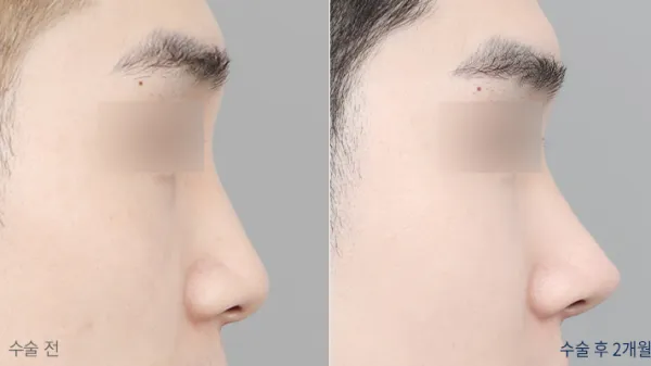 Before/After