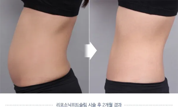 Before/After