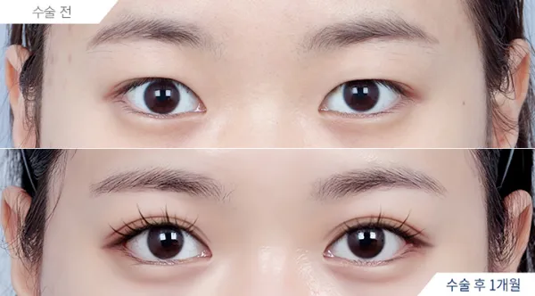 Before/After