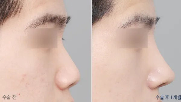 Before/After