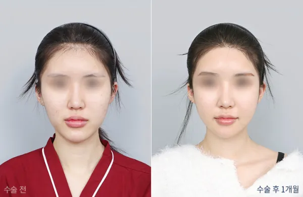 Before/After