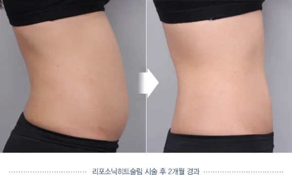 Before/After