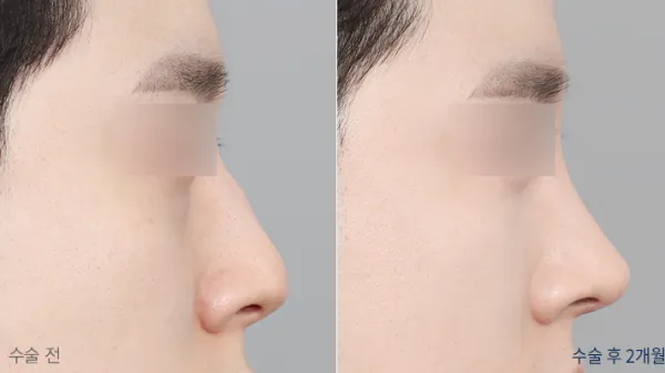 Before/After