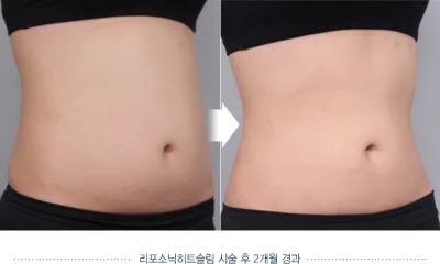 Before & After