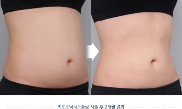 Before/After