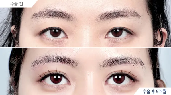 Before/After