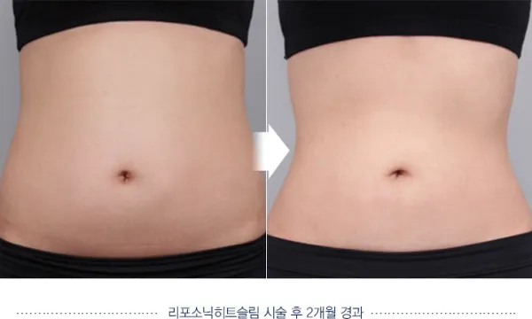 Before/After
