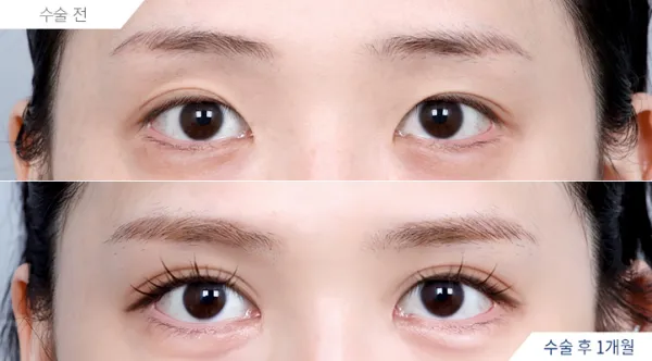 Before/After