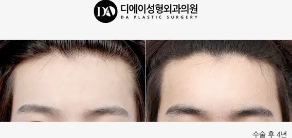 Before/After