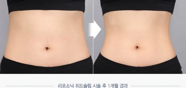 Before/After