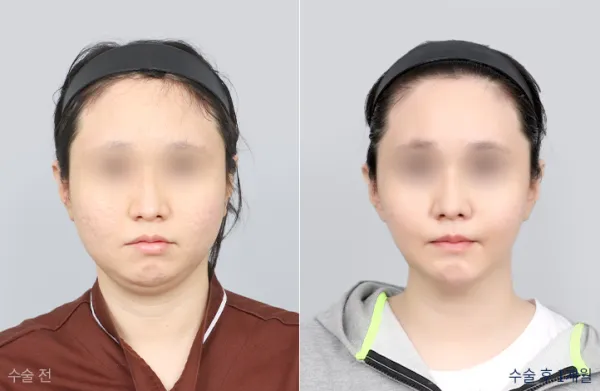 Before/After