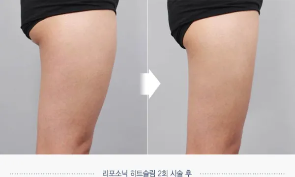 Before/After