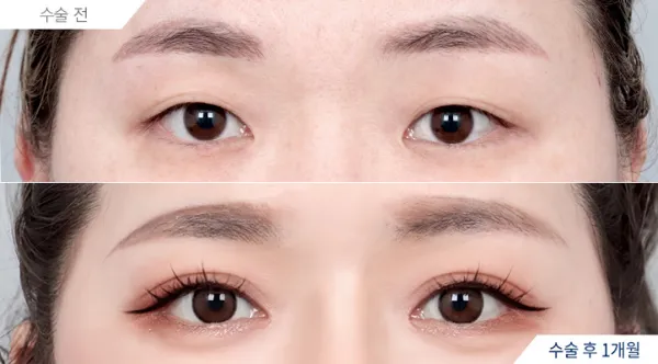 Before/After