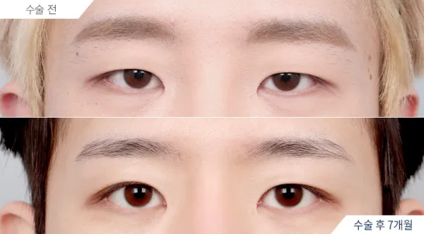 Before/After