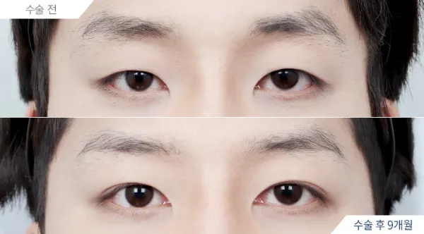 Before/After