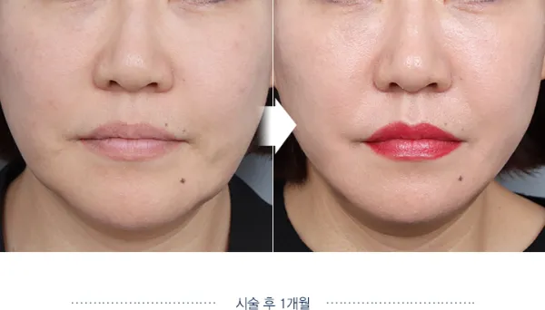 Before/After