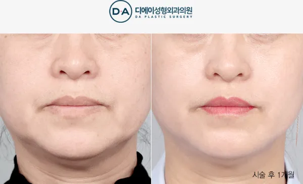 Before/After