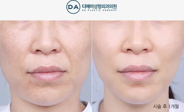 Before/After
