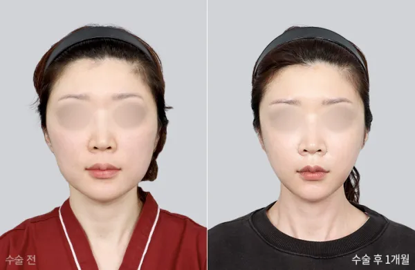 Before/After