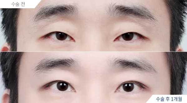 Before/After