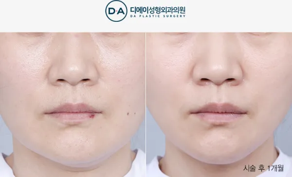 Before/After