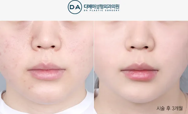Before/After