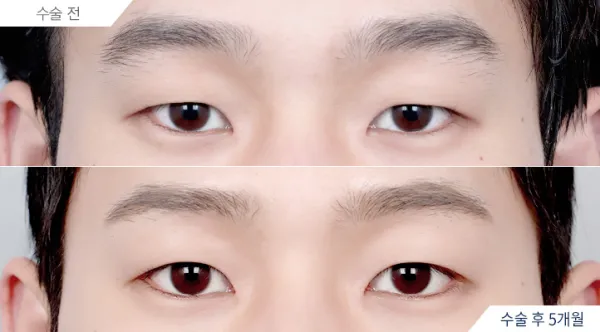 Before/After