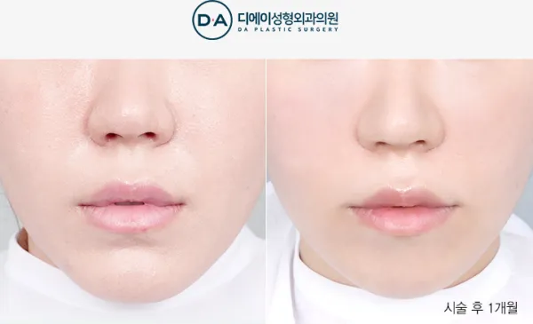 Before/After