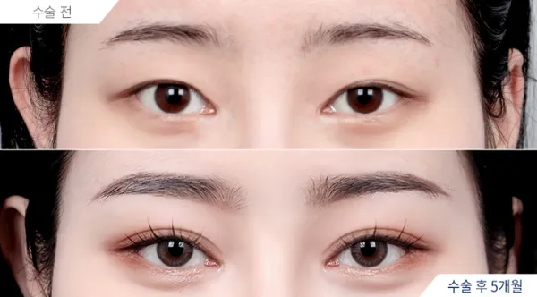 Before/After