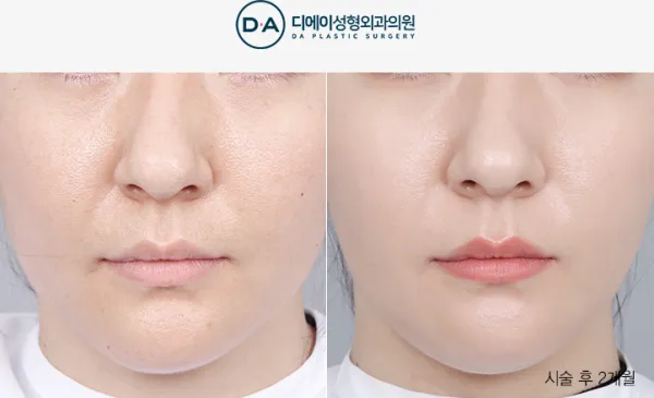Before/After